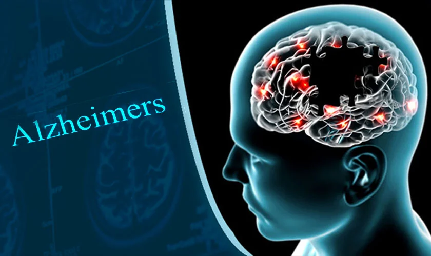 A drug for Alzheimer's