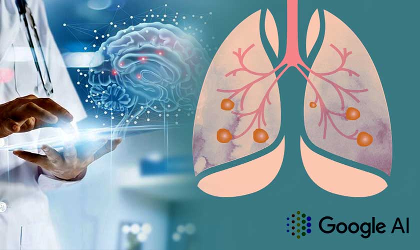 Google using AI to predict lung cancer